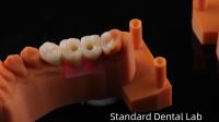 Couronne d'implant dentaire à vis avec PFZ Porcelaine en Zirconia en couche Garantie de 5 ans et modèle d'impression 3D