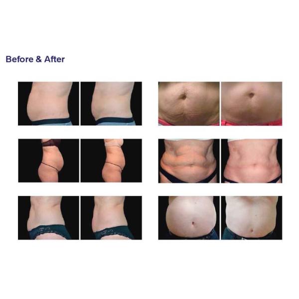 Fast Rf Fat Reduction Machine No Pain With Face Rejuvenation Function