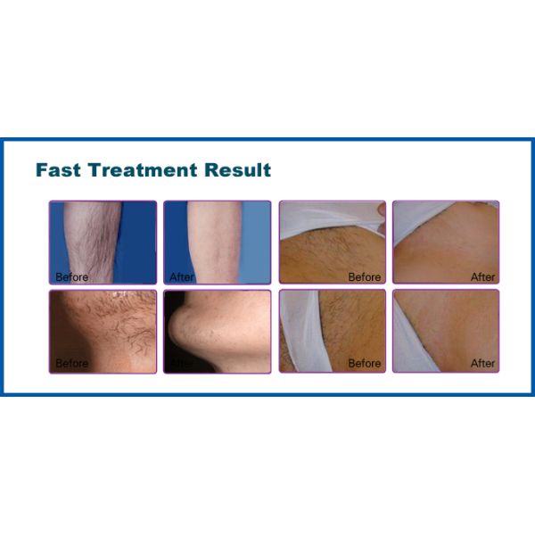 Effective Safe Ipl Beauty Machine For Skin Tightening and Hair Removal