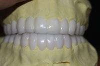 Corona dental temporal de PFM