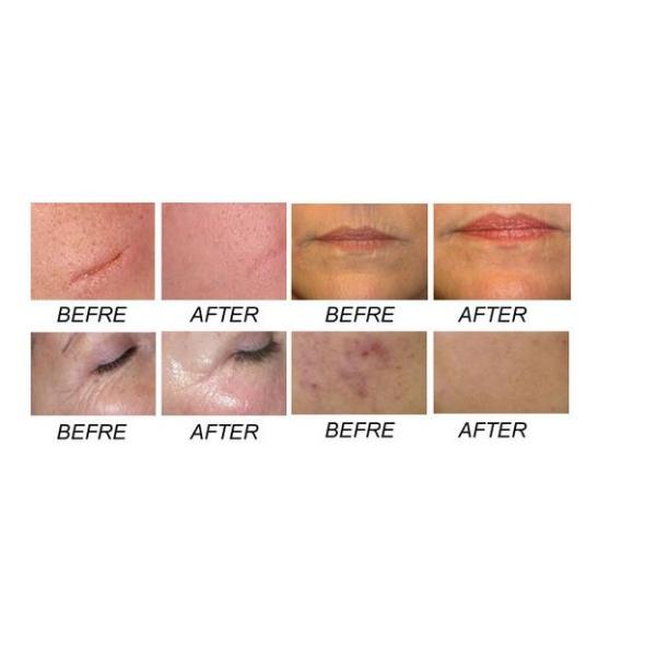 2016 40W Professional Fractional Co2 Laser Machine For Vaginal Tightening With CE Approve