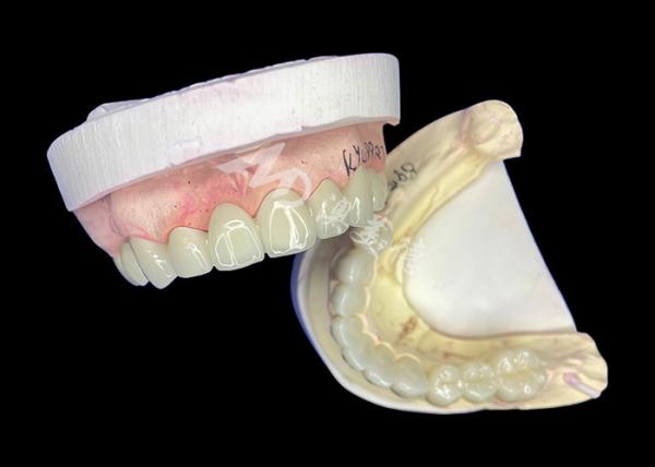 Une couronne de zirconium de lave d'apparence naturelle avec une durabilité inégalée