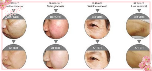 Arm SHR elight Hair Removal Machine Skin Rejuvenation / freckle Removal Machine