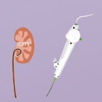 Disposable electronic pyeloscopy with low cost and convenient operation smart disposable electronic pyeloscopy