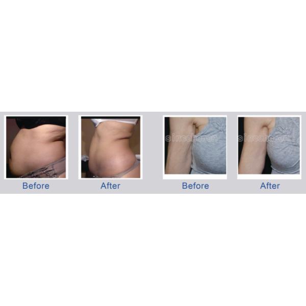 Потеря веса/машина Coolsculpting жирного уменьшения профессиональная