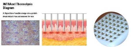 Fractional RF Microneedle For Wrinkle Removal / Skin Tightening