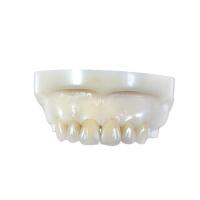 Coronas y puentes de dientes totalmente cerámicos de zirconia