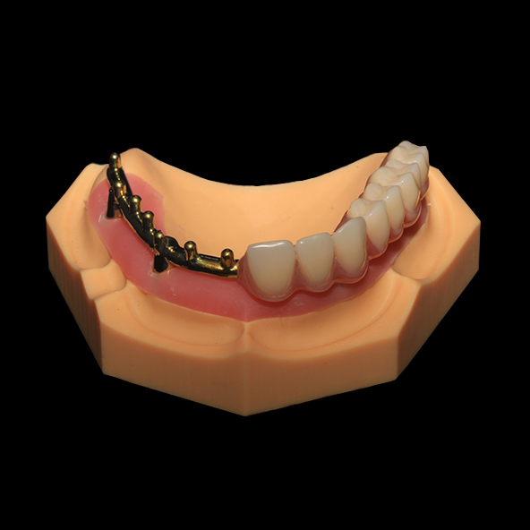 Dental Implant Laboratory | Class 3 Milled Titanium Bar All On X Dental Lmplants With Full Acrylic Denture