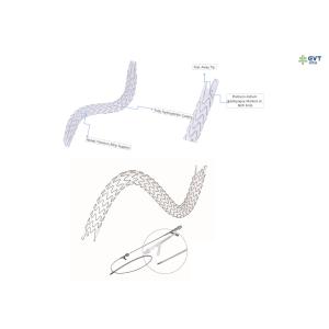 Grand stent urétral à lumière large, conception en nitinol hydrophobe pour un placement précis