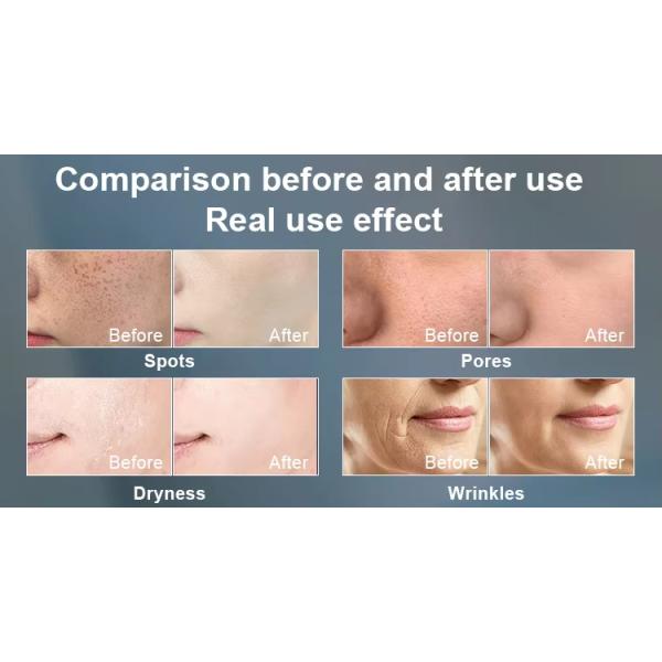 Máquina de depilación y rejuvenecimiento de la piel DPL IPL OPT