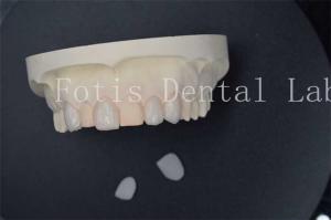 Custom Artificial Dental Lab Veneers With Superior Stain Resistance