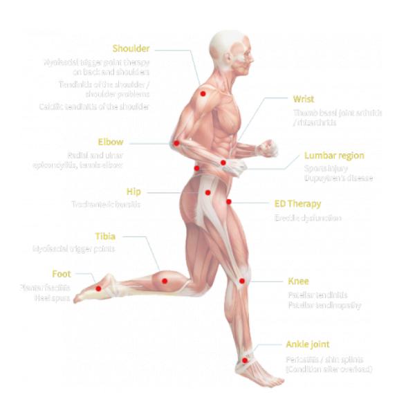 Многофункциональная Ультразвуковая терапия ударными волнами для облегчения боли в шее
