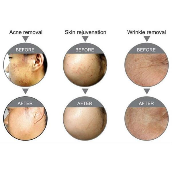 ODM Multifunction RF Ipl Skin Rejuvenation Machine