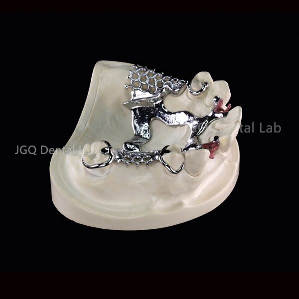 3D Printing Titanium Dental Framework for Customized Removable Dentures