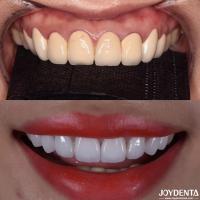 CAD/CAM Compatible Zirconia Dental Crowns Precision Manufacturing For Tailored Shades And Sizes