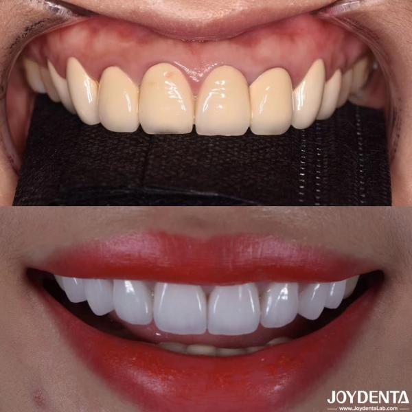 CAD/CAM 互換性 Zirconia 歯冠 調整された色とサイズのための精密製造