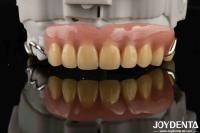 Elaborar el marco de la estructura oral estable y estable para establecer el acabado dental para una salud oral óptima