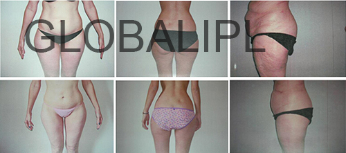 Stationary Style Ultrasonic liposuction cavitation rf slimming machine