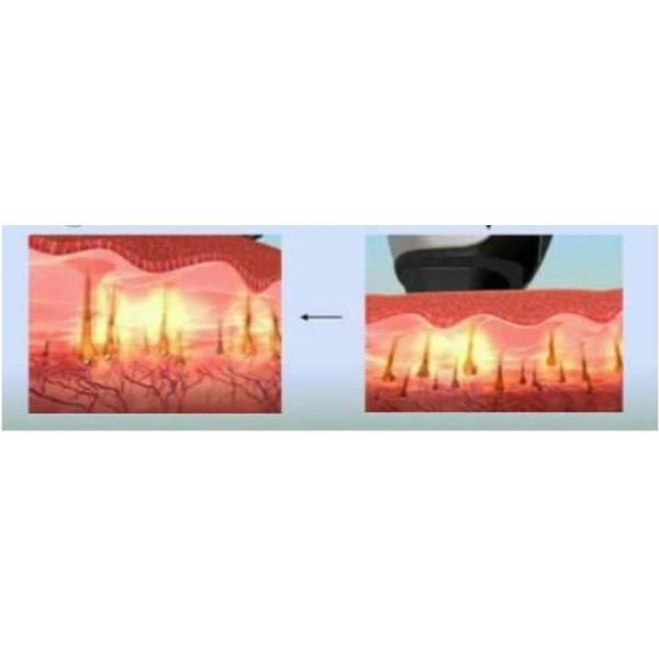 Q switch nd yag laser tattoo removal beauty machine