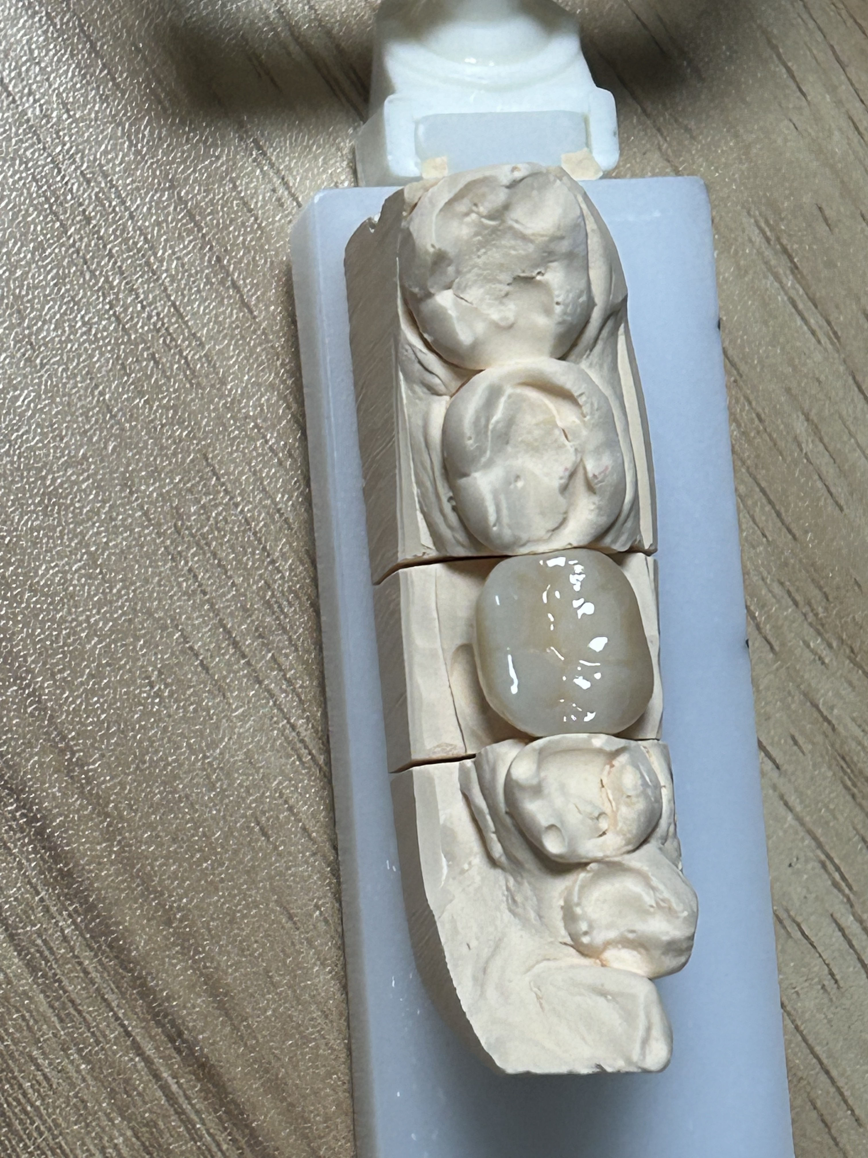 High-Strength Dental Zirconia Crown with Patient-Specific Digital Design and CAD/CAM Production for Posterior Teeth