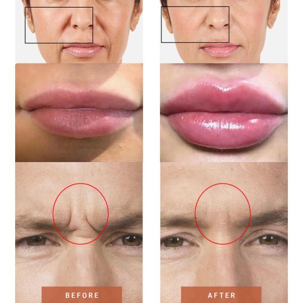 Ultra 3 Ultra 4 Juvederm Dermal Filler Инъекции наполнителей для увеличения губ с гиалуроновой кислотой