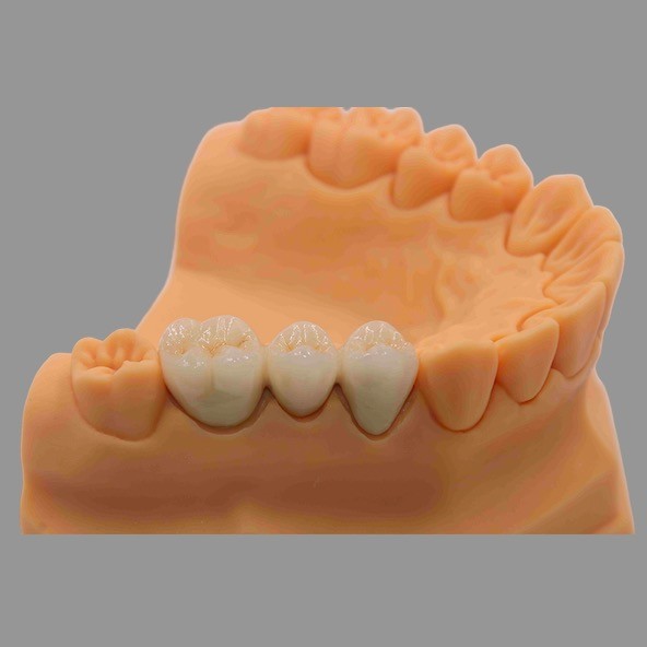 Dental PFM Crown And Bridge Customizable With CoCr Ceramic Materials