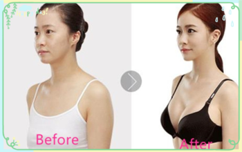 заполнитель Хялуроник кислоты 1.0мл лицевой, гель Хялуроник кислоты впрыски для стороны