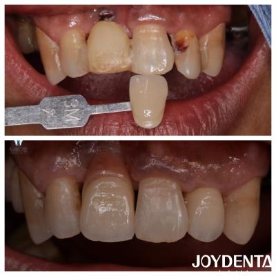Customized Dental Zirconia Veneers Natural Color Lifelike Restorations Tooth Appearance