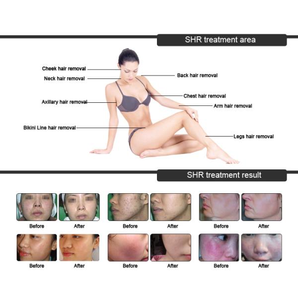 Домой ОПТ IPL лазерная машина Постоянное отбеливание кожи лазерная обработка машина