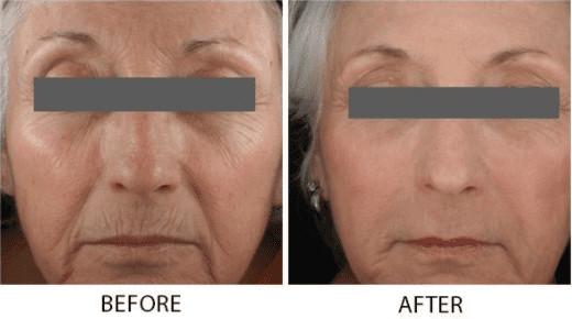 Fractional Laser Skin Resurfacing Machine , CO2 Viginal Skin Rejuvenation Machine