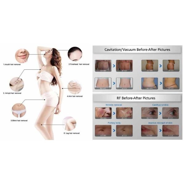 RF Cavitation Vacuum Fat Loss Device for Visible Results and Enhanced Body Contouring