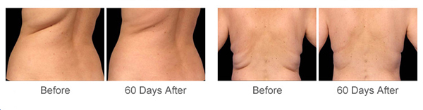 Coolingsculpture Cryolipolysis Body Slimming Machine Professional For Weight Loss