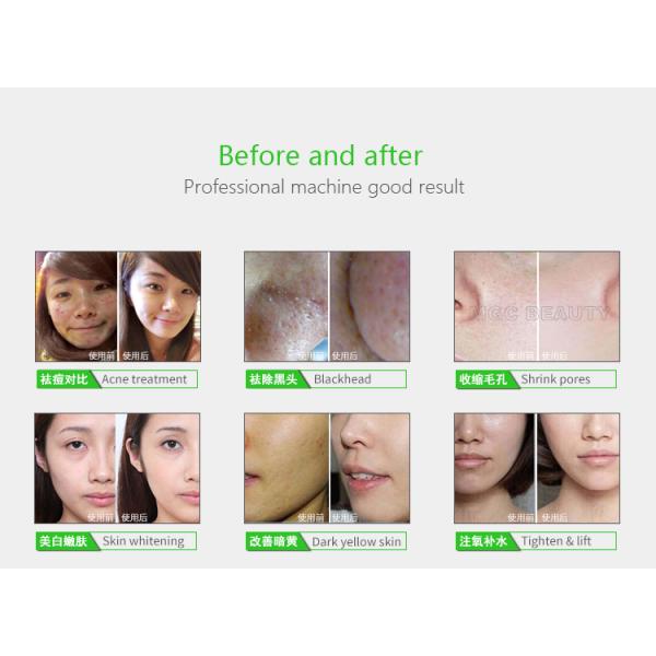 La máquina 3 en 1 Oxy Peel elimina las arrugas Blackhead revitaliza el dispositivo facial de la piel