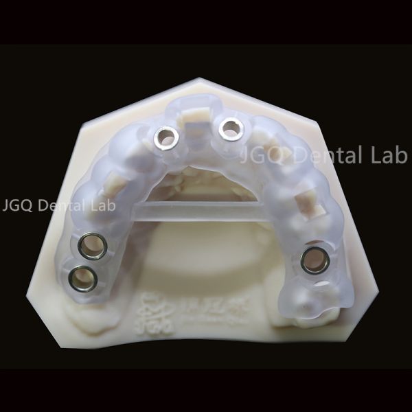 Dental Lab Customized Surgical Guide For Dental Implants 3D Laser Printing