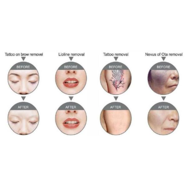 Cavitation Fat Reduction Male Body SHR Hair Removal Machine Spanish Version