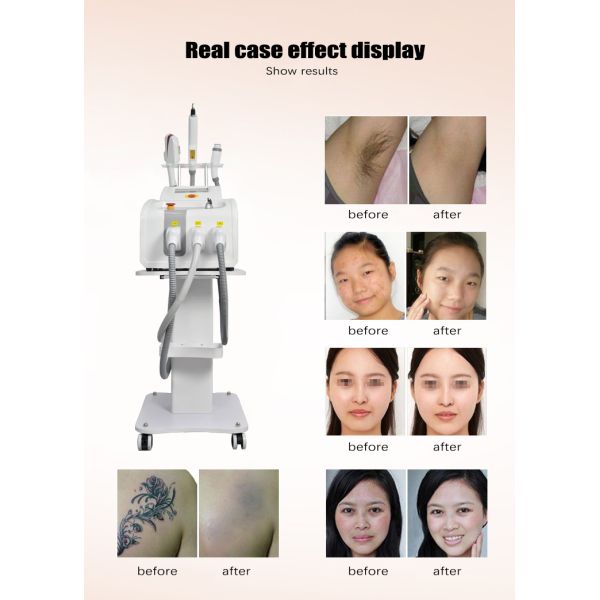 3 IN 1 DPL Beauty Machine laser hair removal machine Laser mole removal, tattoo removal Multifunctional portable beauty machine