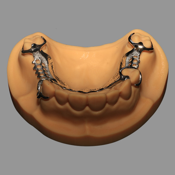 3D Printed CoCr Metal Framework Partial Nickel Free Lightweight