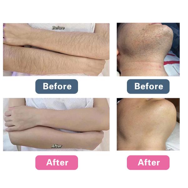 Diode laser KM 4 longueurs d'onde 808nm 755 808 940 1064NM pour épilation, équipement de beauté laser