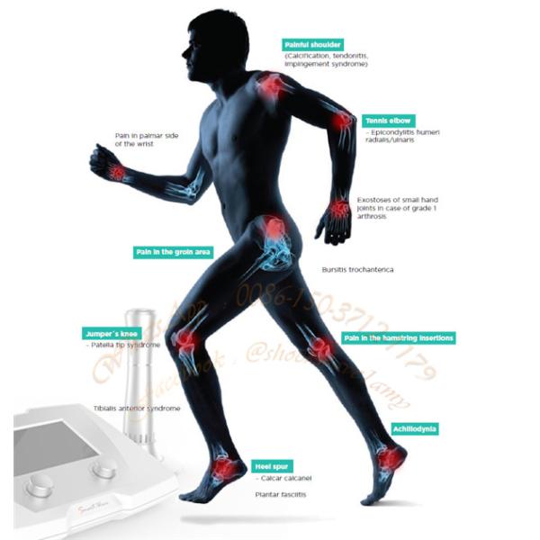 Low Intensity Extracorporeal Shockwave Therapy , Shock Wave Treatment For Heel Pain