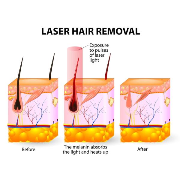 Permanent efftect ! 808nm diode laser hair removal machine in best price!