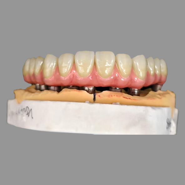 Implantes AOX Clase I All On 4 Híbrido Titanio Atornillado Retenido Zirconia Completa