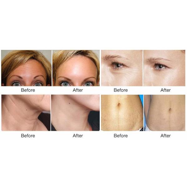 220V 110V RF Beauty Machine 40.68Mhz Radio Frequency Skin Tightening Machine