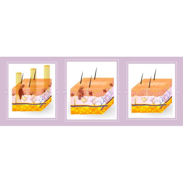 Eyebrow Tattoo Removal Laser Beauty Machine , Nd Yag Laser Tattoo Removal Machine