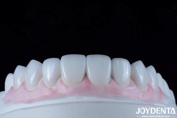Finition dentaire composite durable Bonne biocompatibilité Pas de goutte de finition de porcelaine