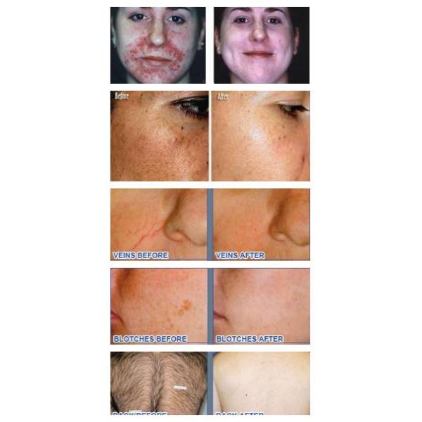 Best Selling IPL Hair Removal/Skin Rejuvenation/Vascular Removal Machine NBW-I323