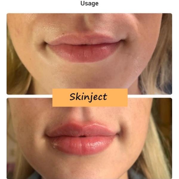 Заполнитель морщинки Skinject 10ml глубокий вводимый для дермального ухода за лицом