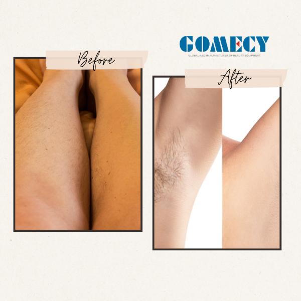 2025 AI Skin Analyzer 4 Wavelength Diode Laser Hair Removal Machine 755nm 808nm 940nm 1064nm Painless Permanent