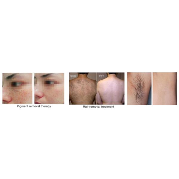 Wrinkle Remove E Light Laser Hair Removal Machine  Fast Shots AFT SHR  For Salon SPA