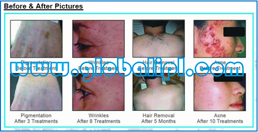 Лазер Elight IPL красотки Liftup груди удаления волос с машиной 4 Handpieces