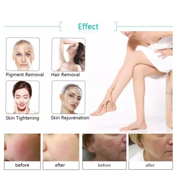 Strong Power Hair Removal Intense Pulse Light Dual Handpieces Laser Hair Removal Medical Equipment IPL Profesional